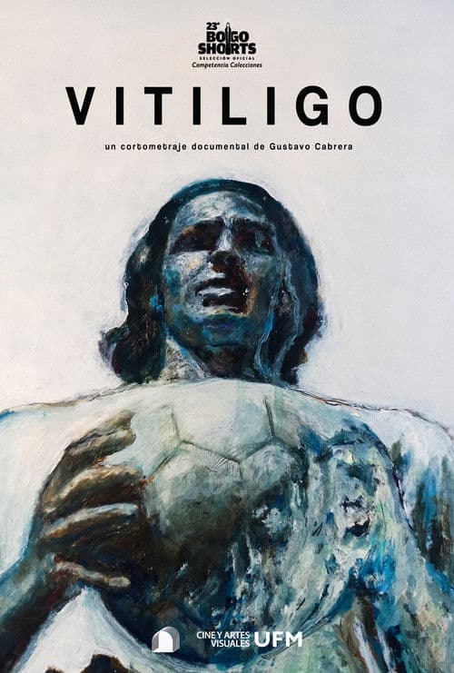 Vitiligoのポスター
